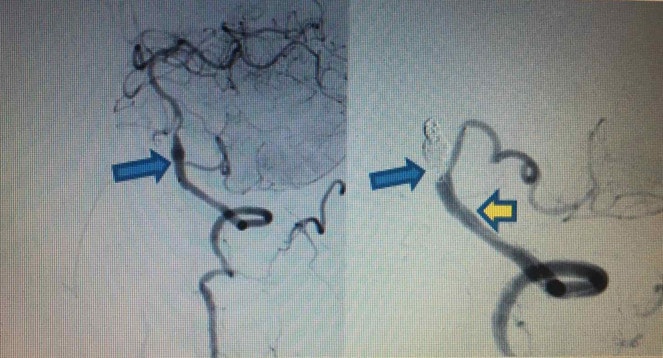 Hình ảnh trước và sau can thiệp (trái: Phình hình thoi bóc tách động mạch) và (phải: Đặt stent động mạch đốt sống - PICA trái và bít coils tắc hoàn toàn phình hình thoi)