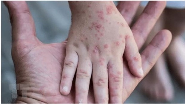 WHO cảnh báo nguy cơ lây lan virus đậu mùa khỉ ở trẻ em -0