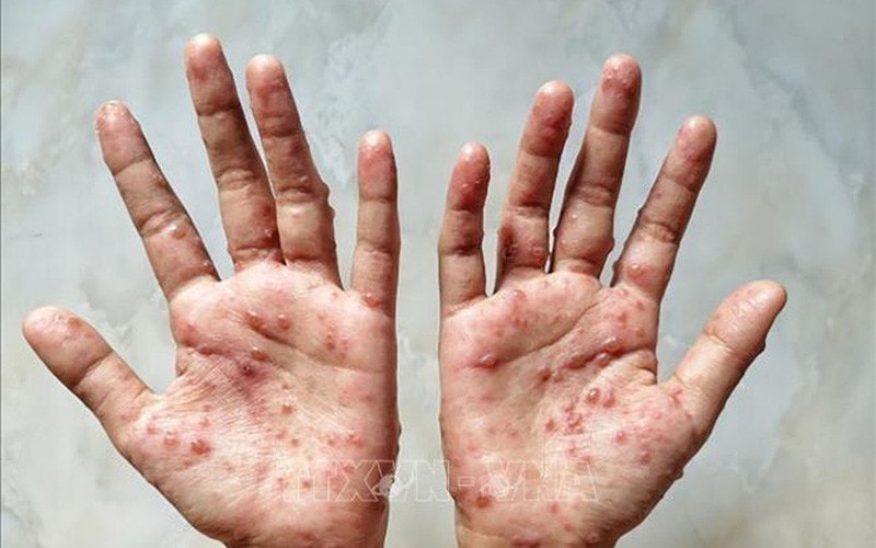 Bộ Y tế khuyến cáo 6 biện pháp phòng bệnh đậu mùa khỉ -0