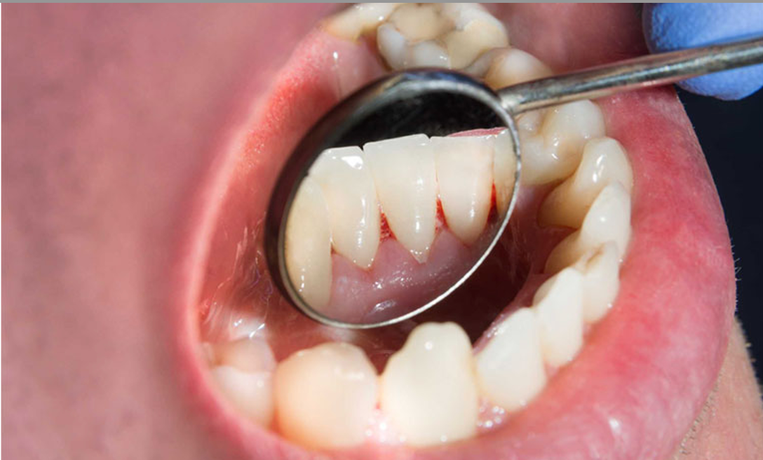 Chảy máu chân răng có thể là tín hiệu cảnh báo những căn bệnh nào? -0