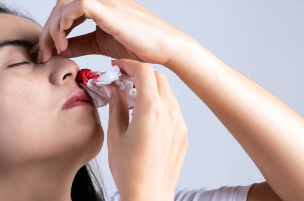 Xử trí thế nào khi bị chảy máu cam? -0