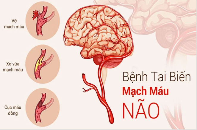Cảnh báo nguy cơ tai biến mạch máu não ở người trẻ -0