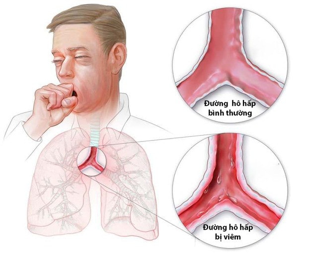 Cách hạn chế viêm đường hô hấp trên khi thời tiết lạnh -0