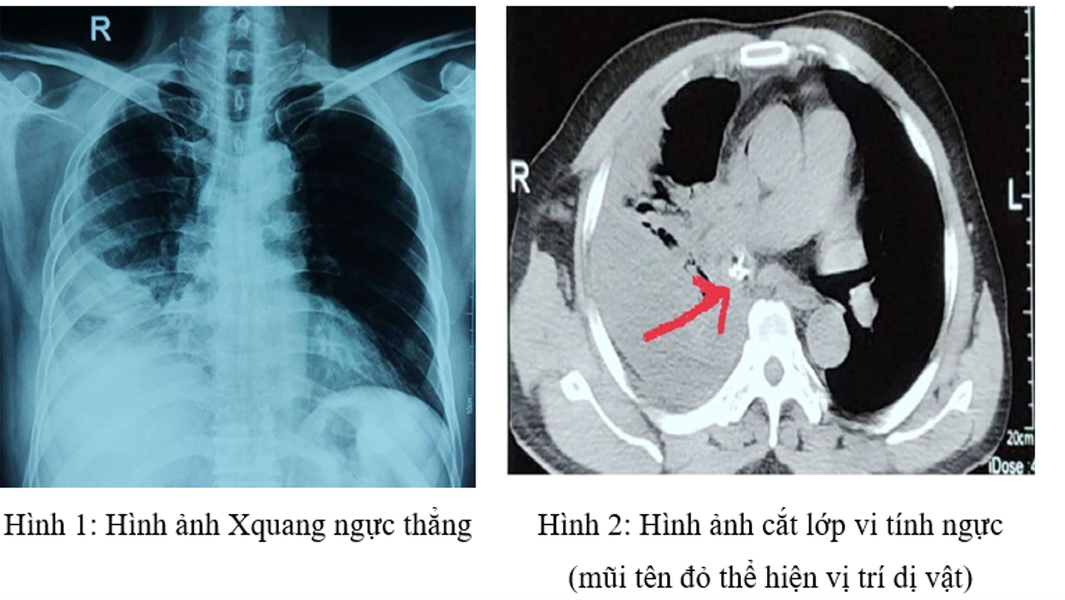Cảnh báo nguy hiểm từ tình trạng sặc dị vật khi ăn -0