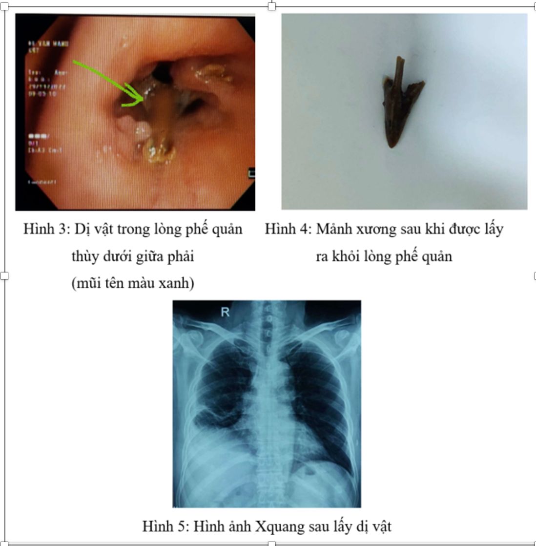 Cảnh báo nguy hiểm từ tình trạng sặc dị vật khi ăn -0