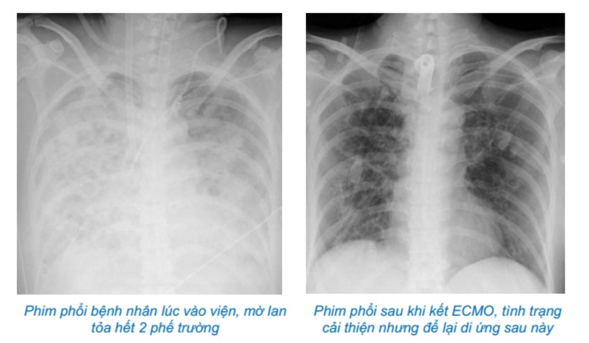 Tự điều trị cúm, bệnh nhân phải chạy ECMO 37 ngày do viêm phổi bội nhiễm -0