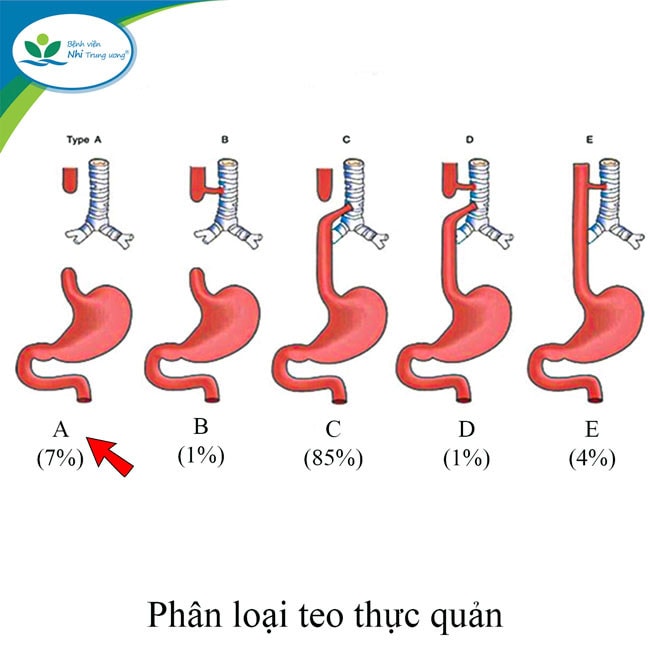“Tạo hình thực quản bằng đại tràng” cho bé gái bị teo thực quản hiếm gặp -0