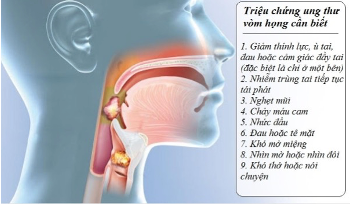 Những điều cần biết về nguy hiểm của ung thư vòm họng -0
