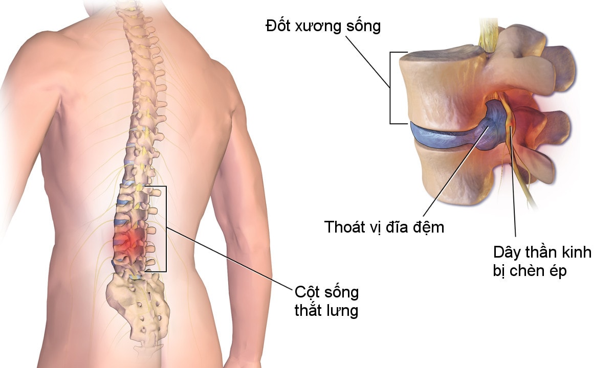 Nguyên nhân gây thoát vị đĩa đệm cột sống thắt lưng  -0