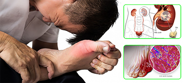 Chế độ dinh dưỡng cho người mắc bệnh Gout trong dịp Tết -0