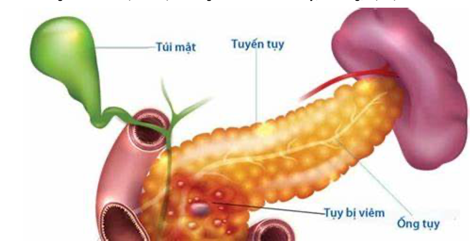 Rượu bia kéo dài nguy cơ viêm tụy cấp 