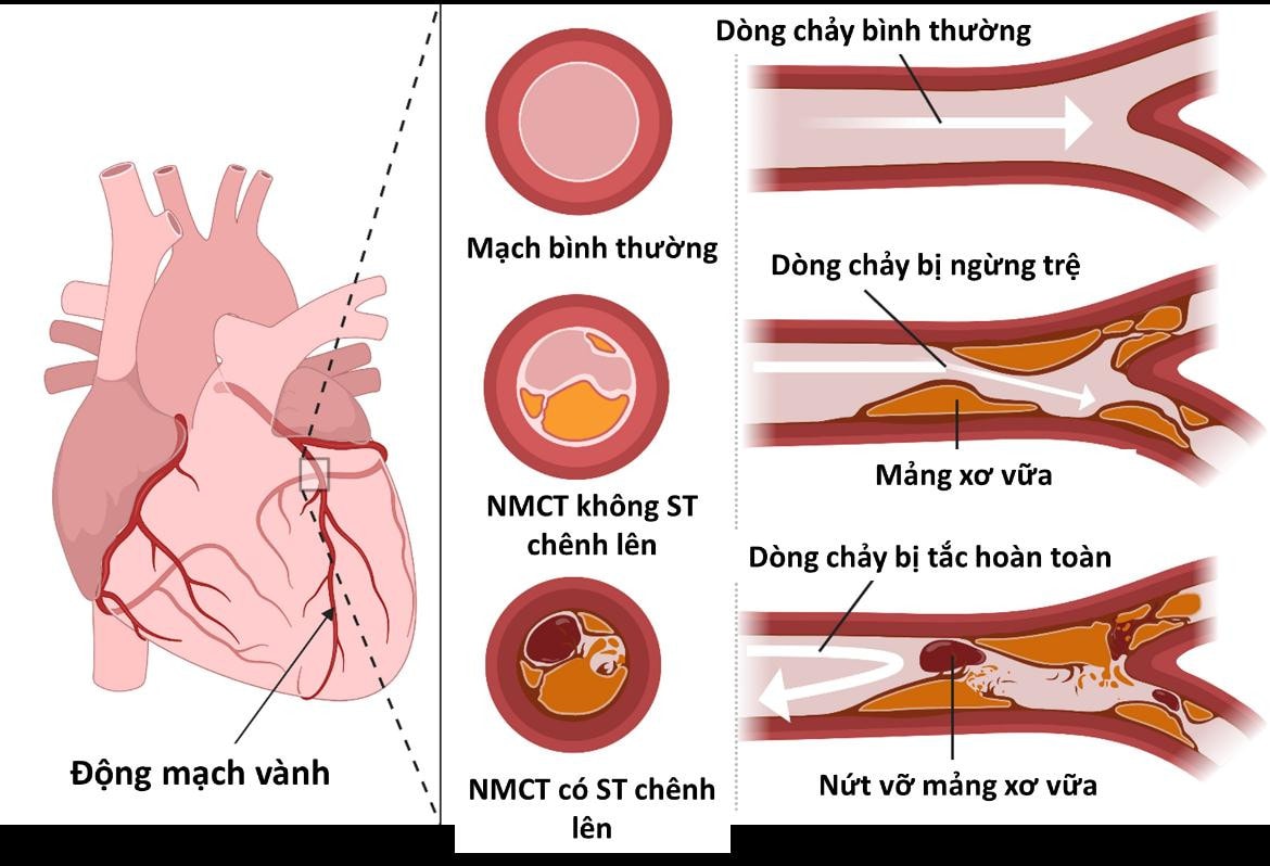  Bệnh nhồi máu cơ tim đang có xu hướng trẻ hoá -0