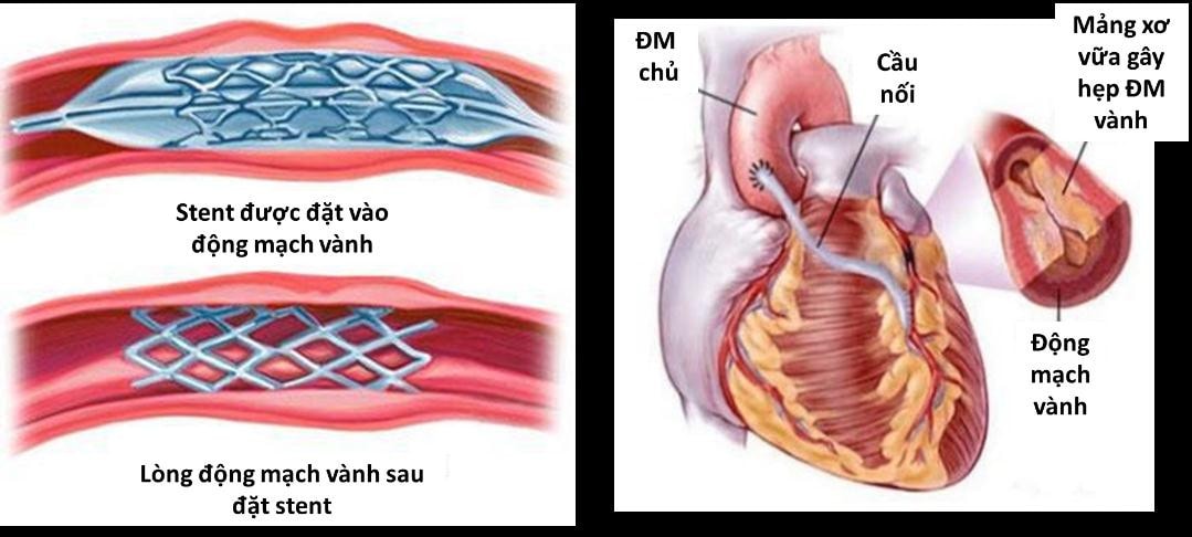  Bệnh nhồi máu cơ tim đang có xu hướng trẻ hoá -0