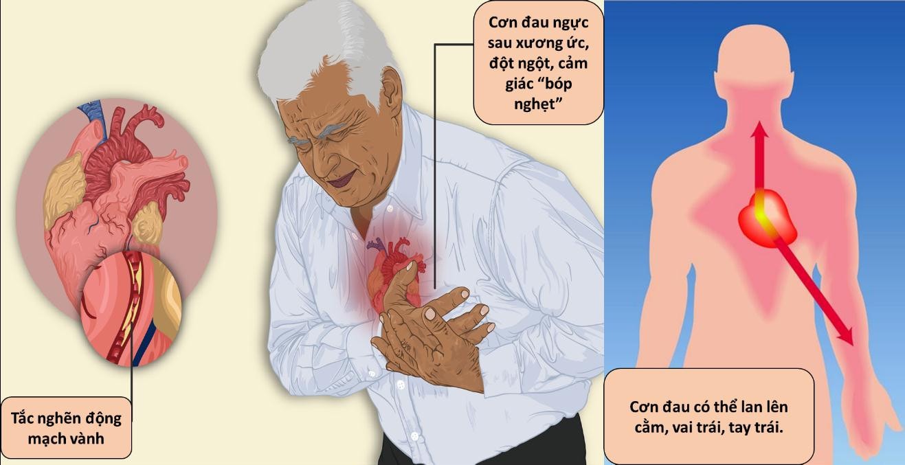  Bệnh nhồi máu cơ tim đang có xu hướng trẻ hoá -0