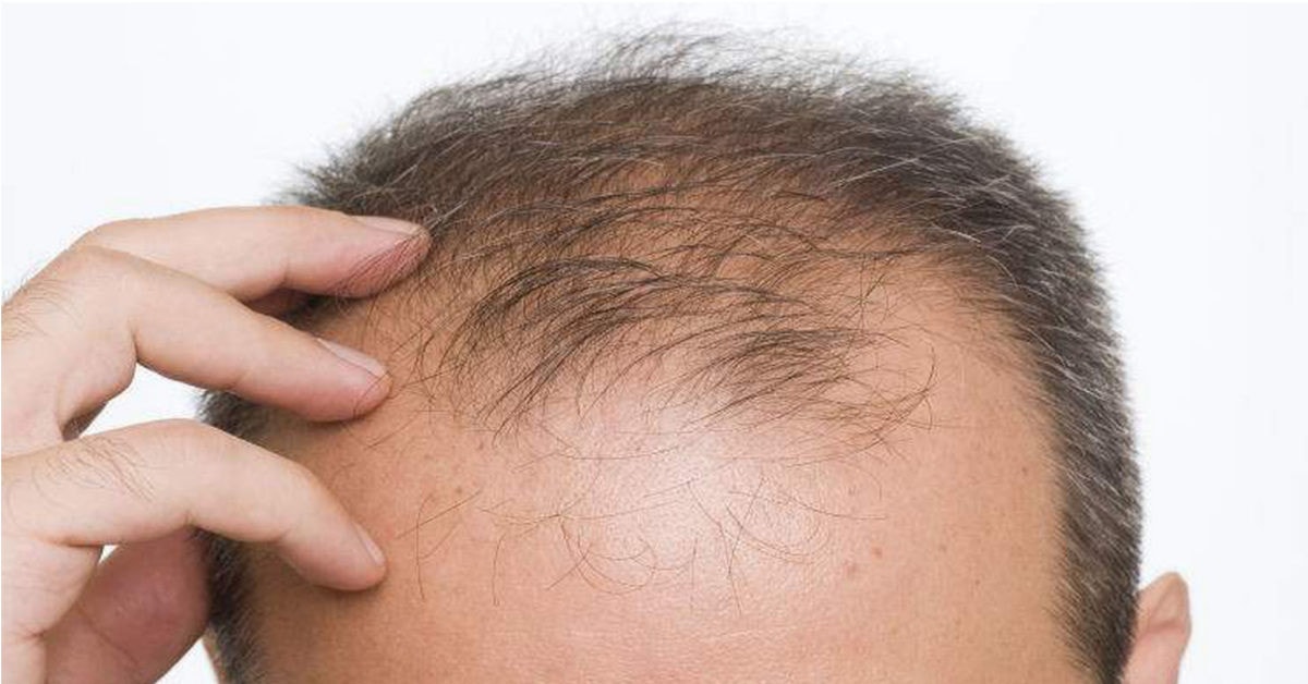 Đồ uống có đường khiến nam giới rụng tóc nhiều hơn -0