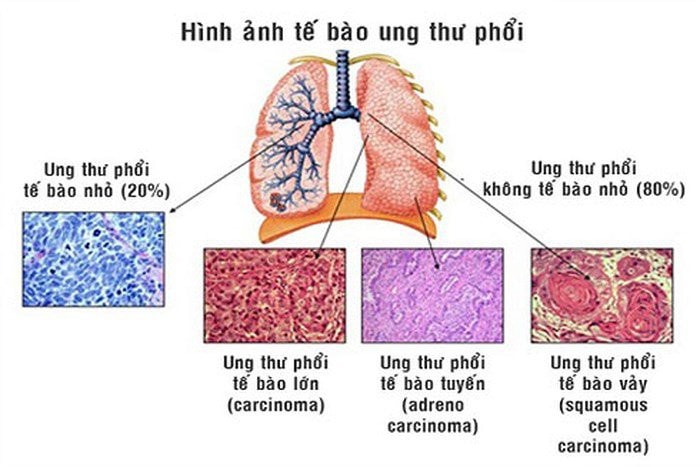 Hút thuốc lá chiếm 80% nguyên nhân gây ung thư phổi -0
