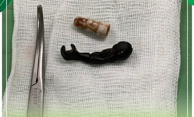 Lấy 2 dị vật trong vùng kín bé gái 5 tuổi -0
