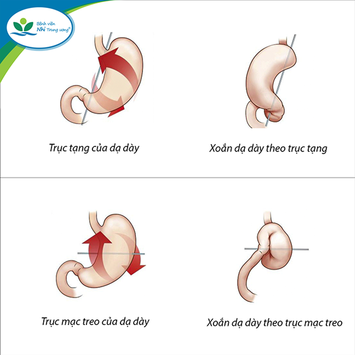 Tưởng con đau bụng do rối loạn tiêu hoá, không ngờ mắc bệnh xoắn dạ dày rất hiếm gặp -0