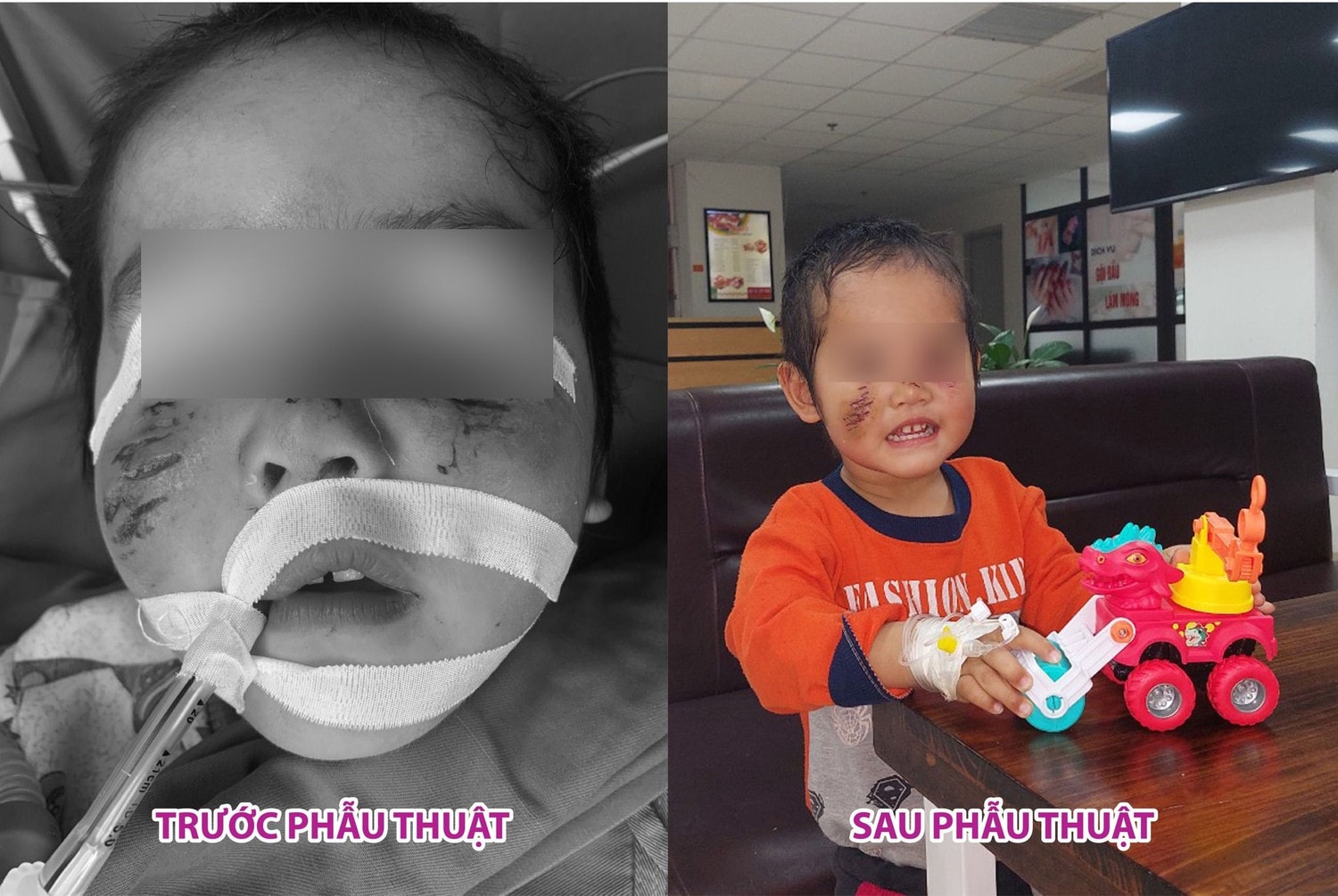 Cấp cứu cháu bé bị chó nhà hàng xóm cắn trọng thương -0