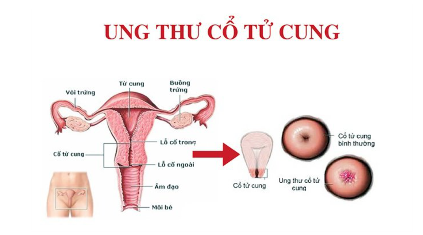 10 dấu hiệu ung thư cổ tử cung -0