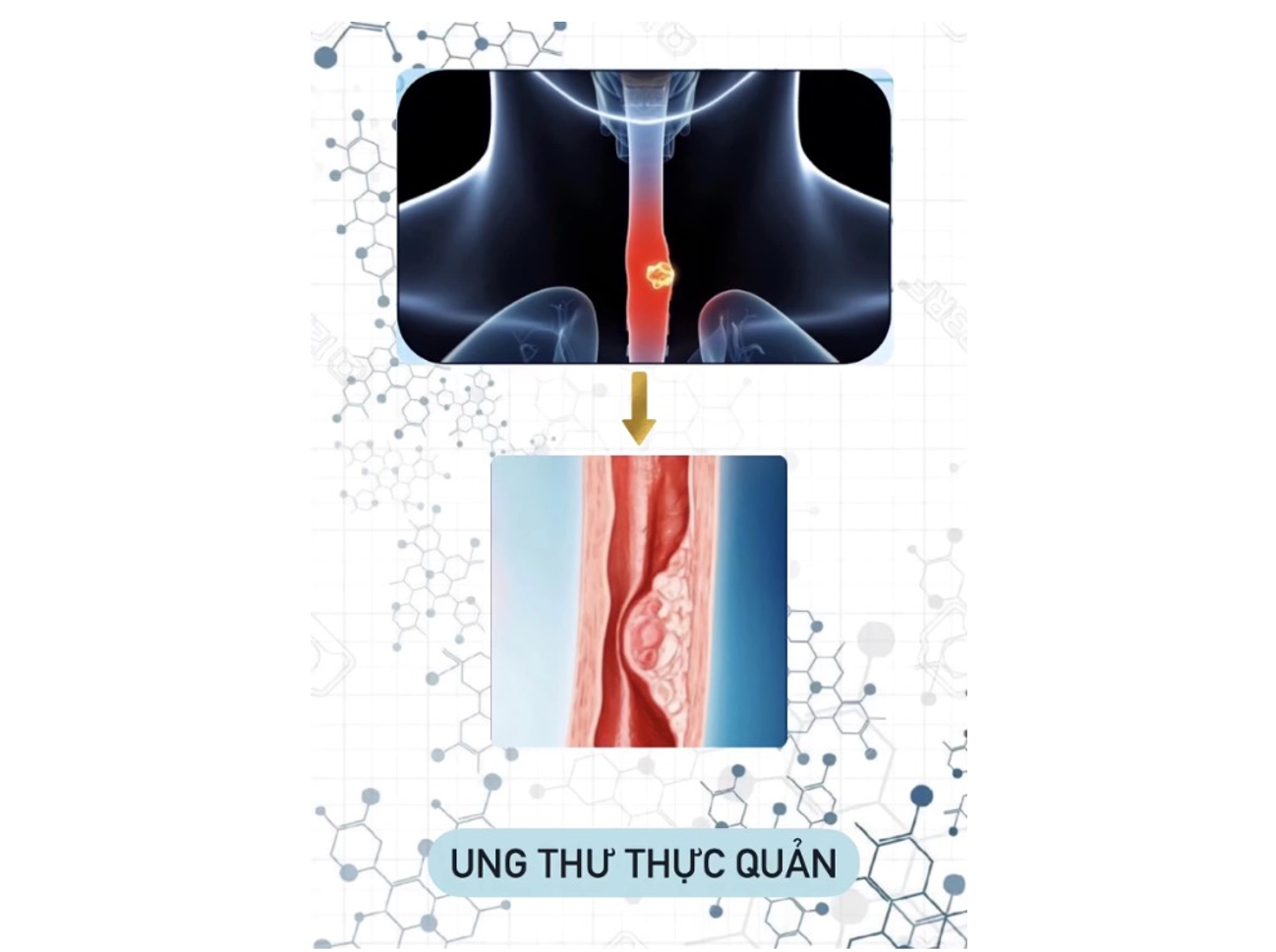 Những thói quen ăn uống làm tăng nguy cơ ung thư thực quản -0