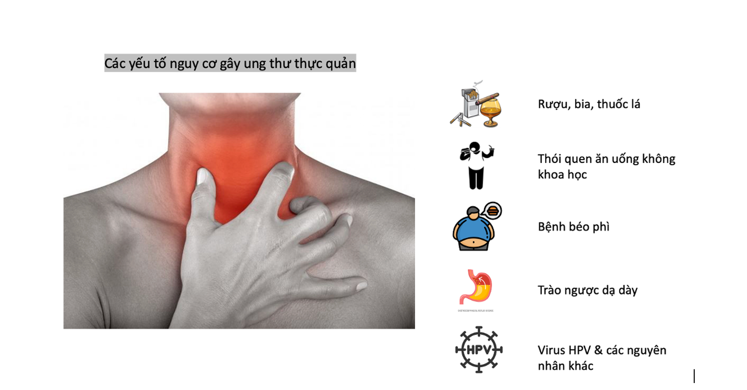 Những thói quen ăn uống làm tăng nguy cơ ung thư thực quản -0