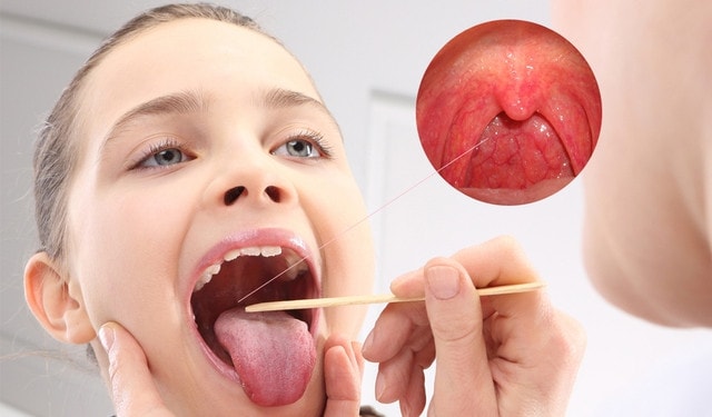 Ho sốt, đau rát cổ… coi chừng viêm họng do liên cầu khuẩn -0