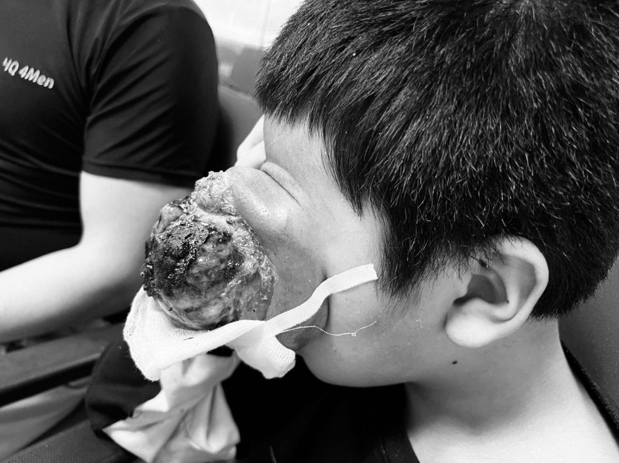 Bé 4 tuổi mang khối u chiếm nửa vùng mặt trái, nhiều bệnh viện từ chối phẫu thuật -0