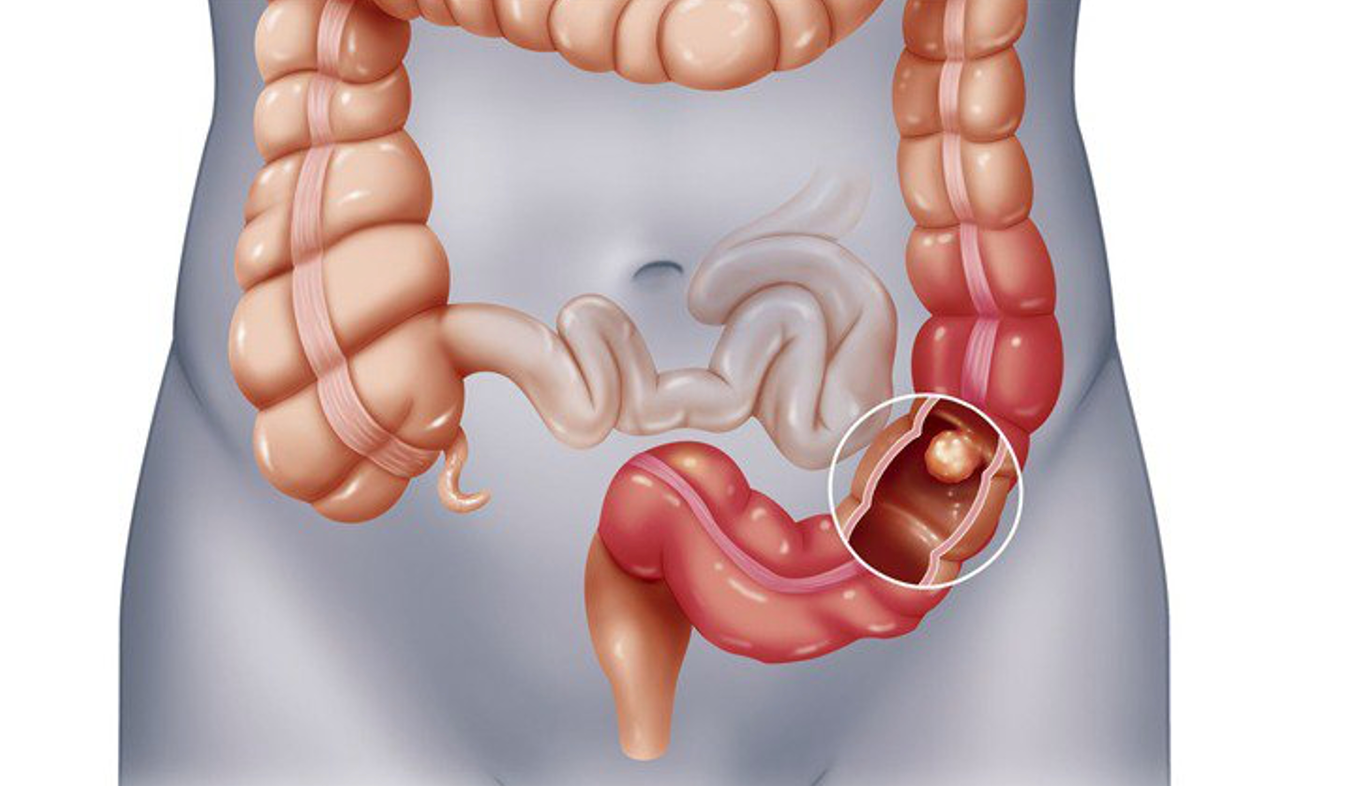 Nữ bệnh nhân 30 tuổi phát hiện ung thư giai đoạn cuối từ tình trạng rối loạn tiêu hóa   -0