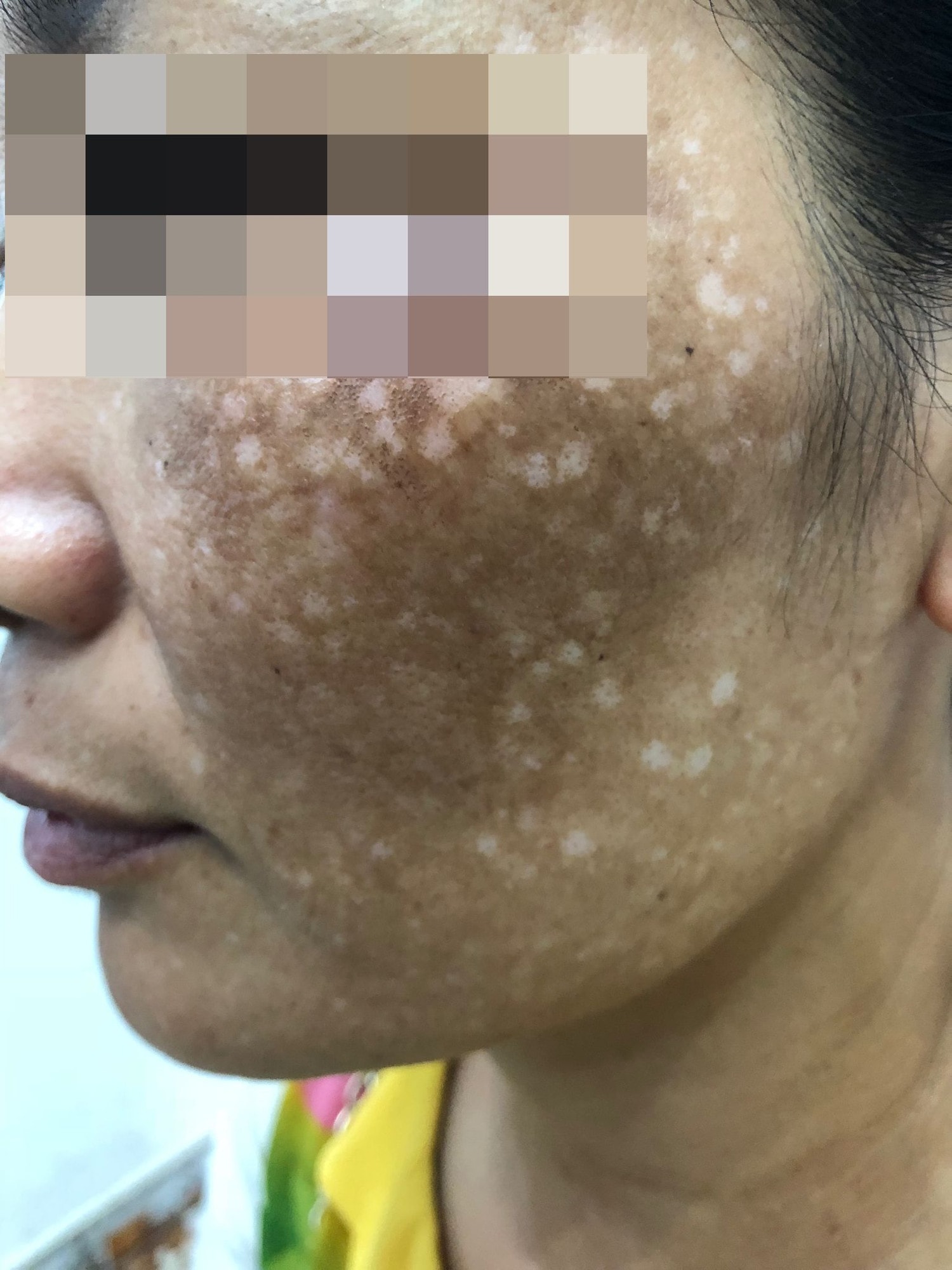 Dùng lá trầu không trị nám da, 4 phụ nữ nhận “kết đắng” chỉ sau một đêm -0