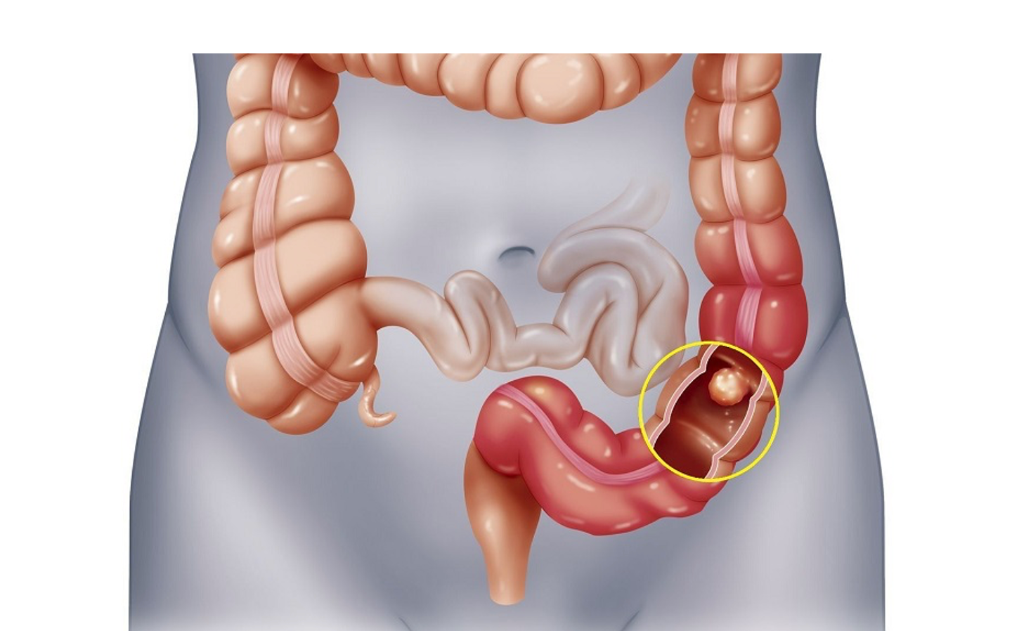 Ung thư đại trực tràng đang có xu hướng gia tăng -0