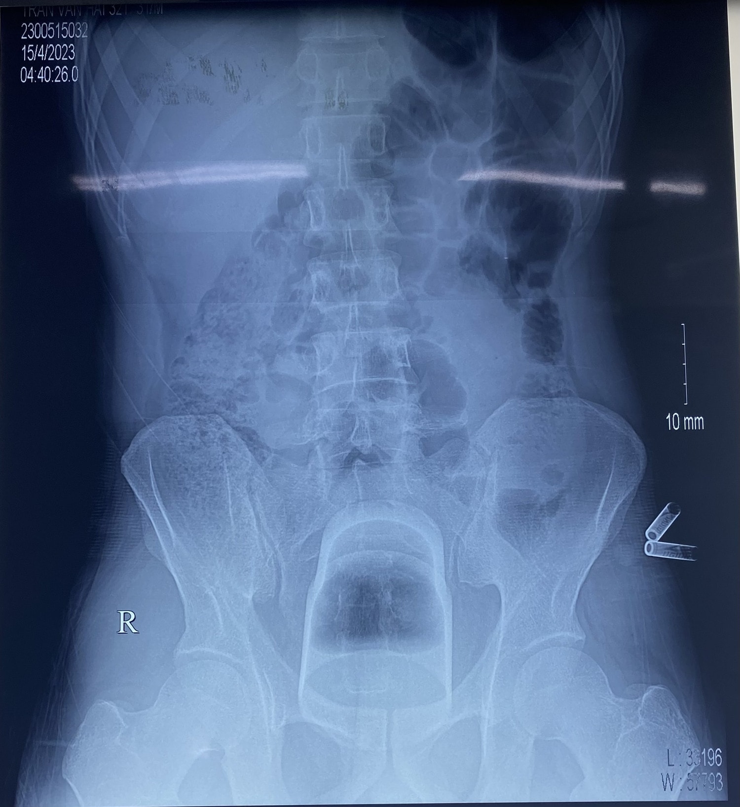 Bệnh viện Việt Đức: Lấy dị vật dài 12cm mắc kẹt rất sâu trong trực tràng của bệnh nhân -0