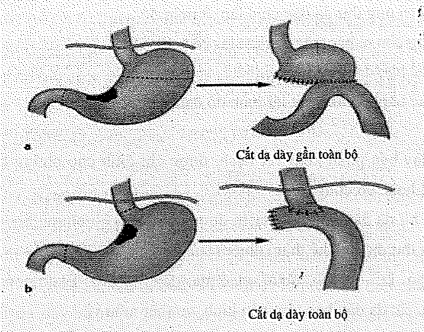 Nguyên nhân dẫn đến ung thư dạ dày -0