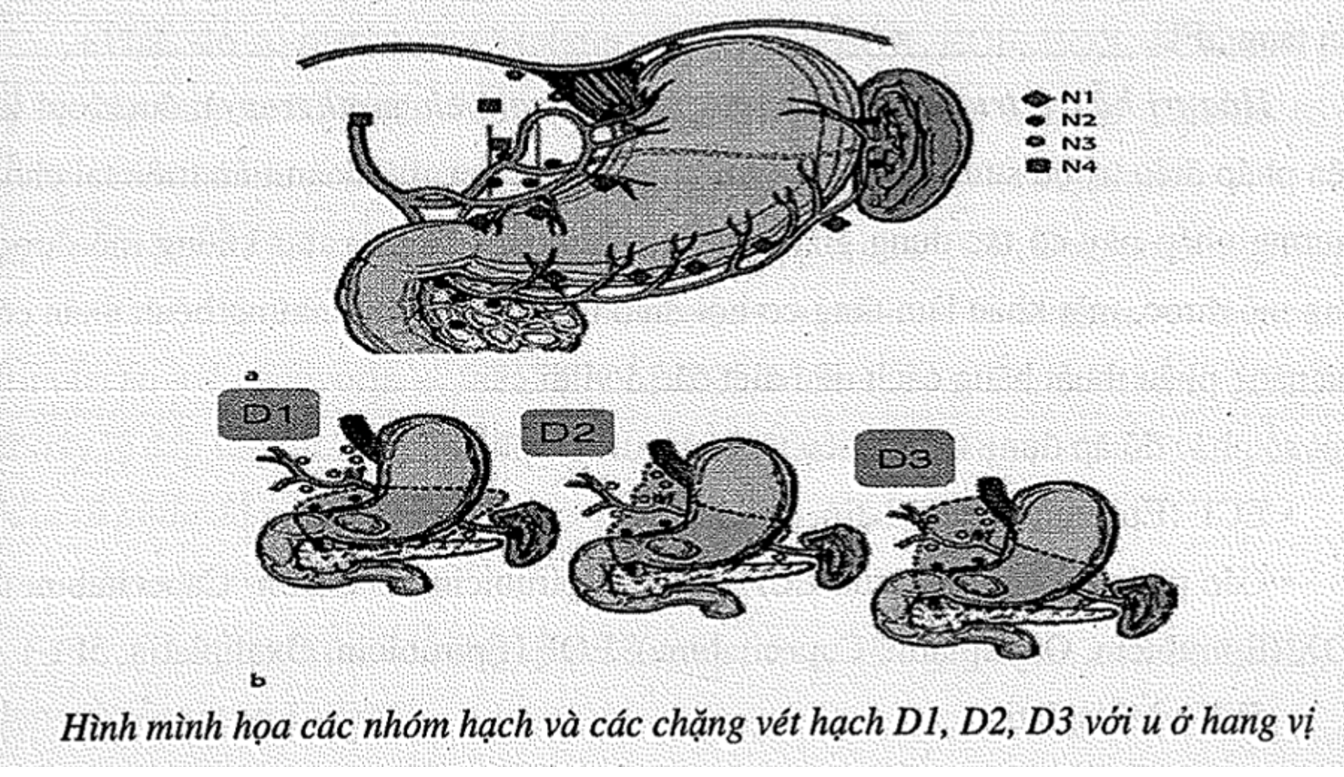 Nguyên nhân dẫn đến ung thư dạ dày -0
