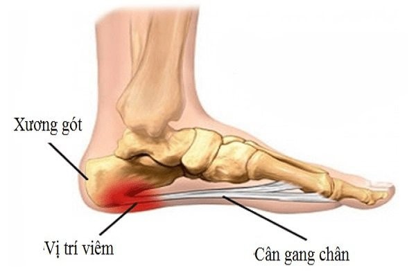 Các triệu chứng phát hiện sớm bệnh Viêm cân gan chân -0