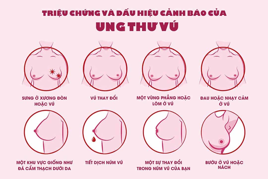 Nhiều trường hợp ngoài 20 tuổi đã mắc ung thư vú, bác sĩ khuyến cáo dấu hiệu sớm phát hiện bệnh -0