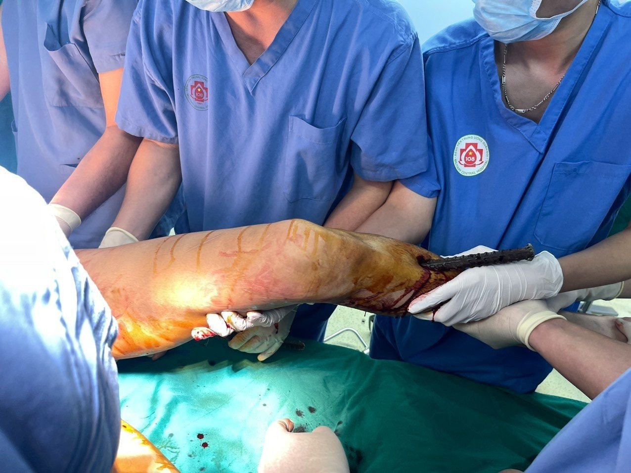 Cứu thành công nam thanh niên 19 tuổi bị 3 cọc sắt đâm xuyên người -0