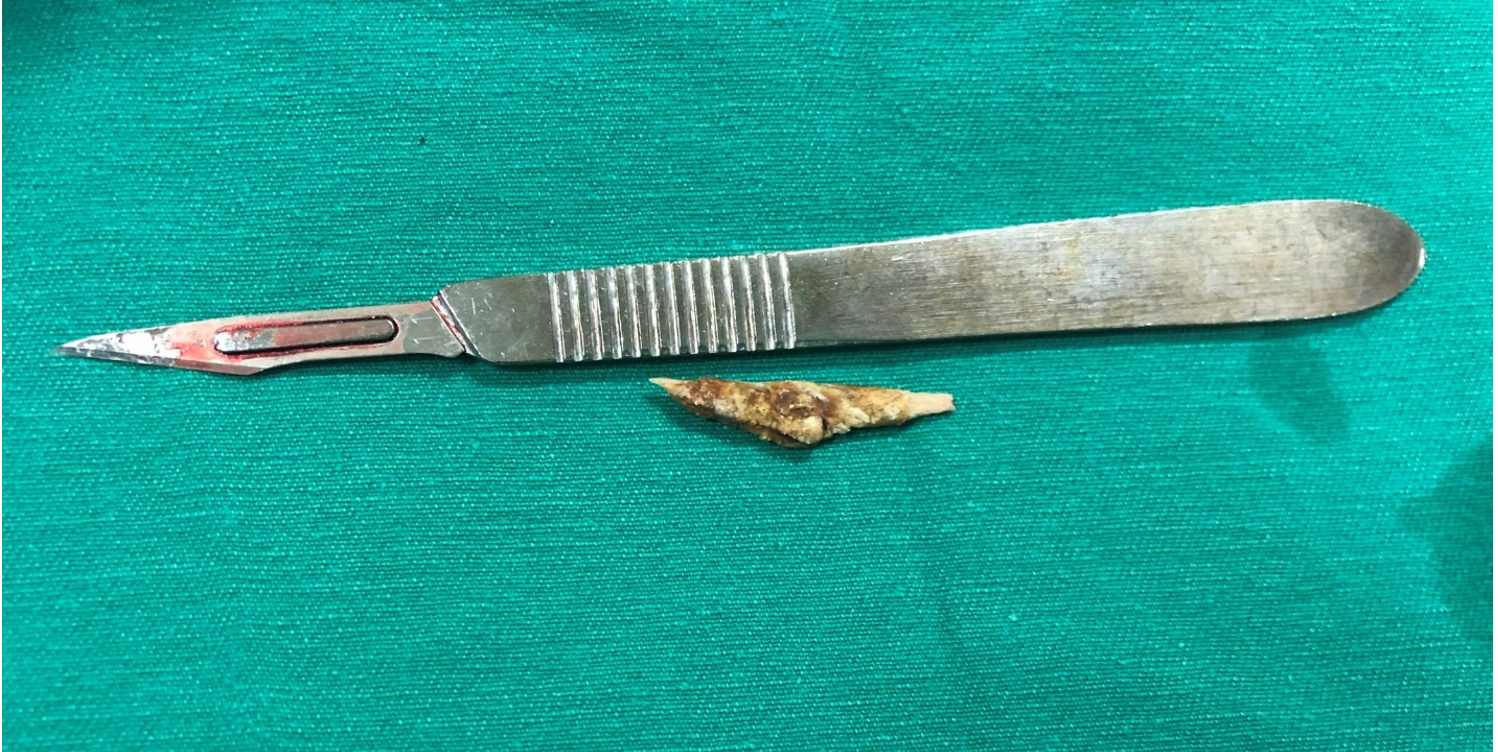 Phát hiện dị vật đâm thủng trực tràng từ triệu chứng đau bụng -0