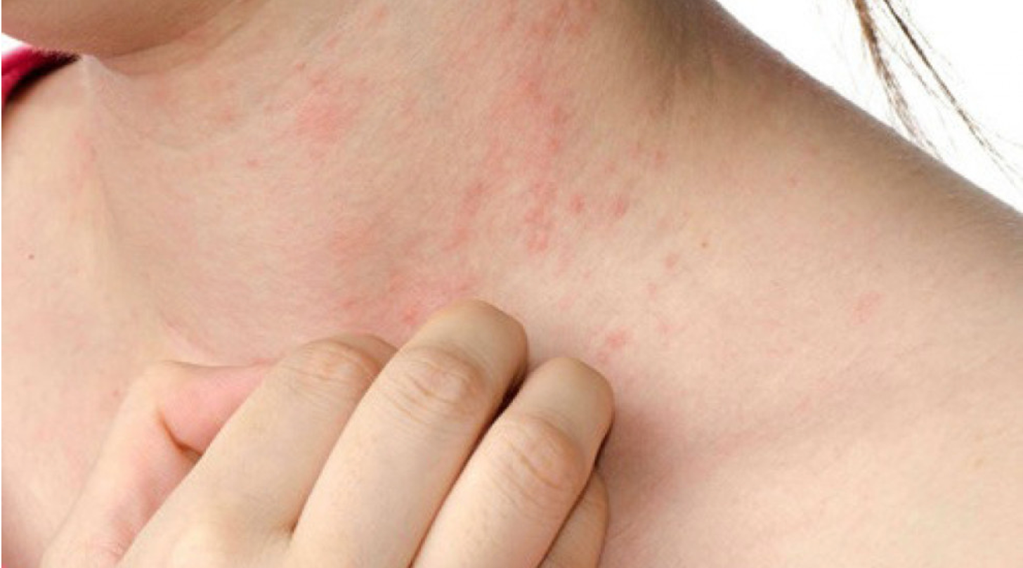 Mùa nắng nóng: Cảnh báo nguy cơ nhiều căn bệnh xuất hiện -0