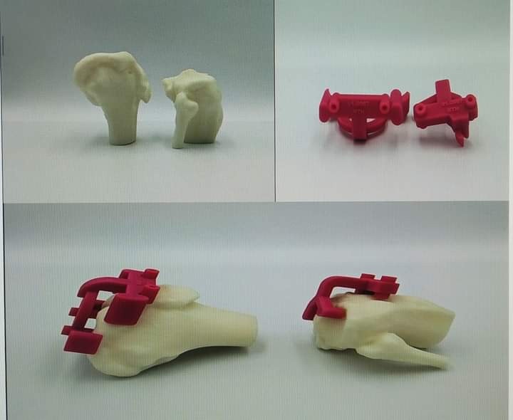 Ứng dụng công nghệ in 3D vào phẫu thuật thay khớp gối -0
