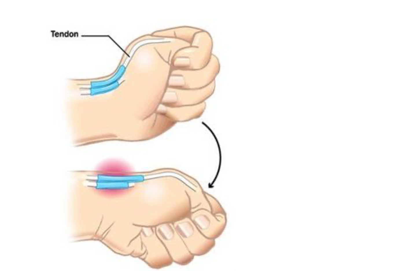Hội chứng De Quervain – nhiều người bị mắc, đau nhưng không biết -0