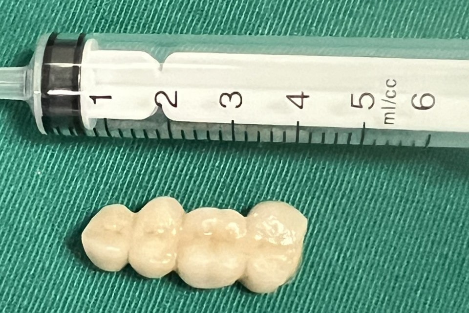 Hy hữu: Răng giả “lạc trôi” trong dạ dày người phụ nữ 60 tuổi -0