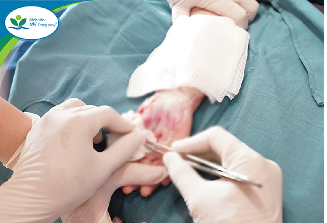 Liên tiếp trẻ bị bỏng nặng do máy chạy bộ, bác sĩ khuyến cáo -0