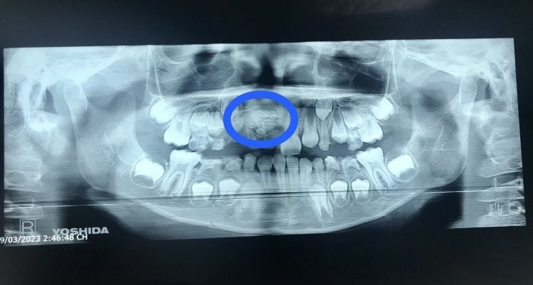 Gắp ra 30 cái răng ở khối u răng của nữ bệnh nhân 17 tuổi -0