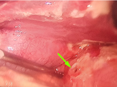 Thủng hành tá tràng, viêm phúc mạc vì áp lực thi cử -0