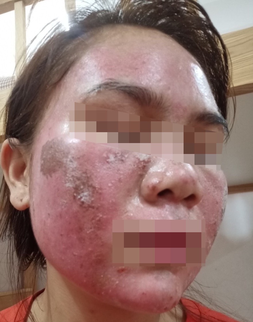 Mê peel da làm đẹp, cô gái hốt hoảng “cầu cứu” bác sĩ sau 2 tuần -0