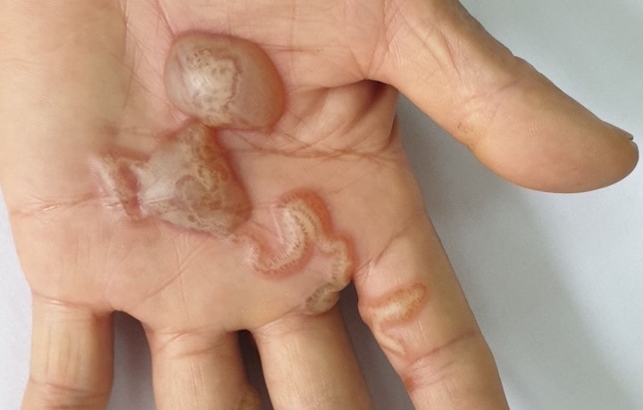 Giun đũa chó mèo ký sinh, gây ngứa ngáy dữ dội nhiều năm vì thói quen này -0