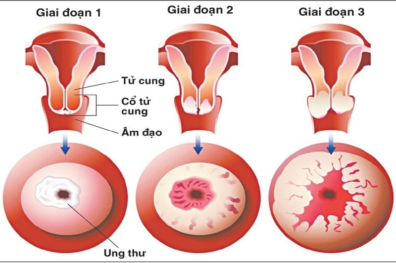 Dấu hiệu ung thư cổ tử cung và Phương pháp phòng ngừa bệnh -0