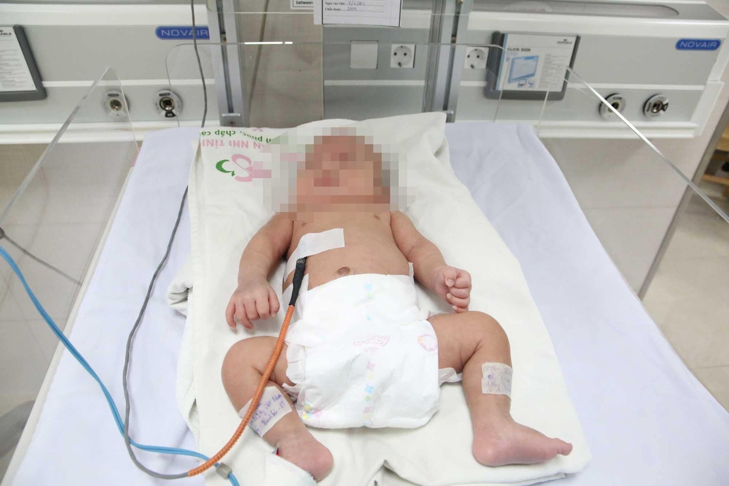 Nuôi dưỡng thành công trẻ sinh non chỉ nặng 700gram khi chào đời -0