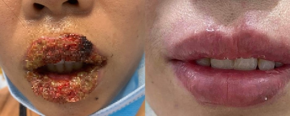 Xăm môi tại spa, nữ sinh 15 tuổi 